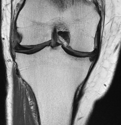 Figure 4 for case chondrocalcinosis within chronic unstable medial meniscus flap tear and adjacent tibial remodeling ( RID5398 )